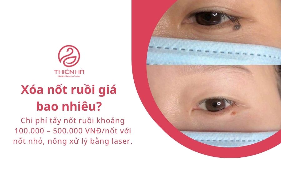 Xóa nốt ruồi an toàn: Phương pháp, chi phí và cách hạn chế sẹo 7 Xóa nốt ruồi giá bao nhiêu?