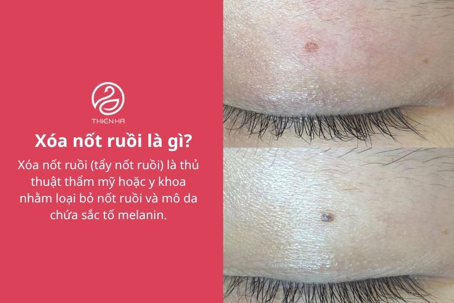 Xóa nốt ruồi an toàn: Phương pháp, chi phí và cách hạn chế sẹo 1 Xóa nốt ruồi là gì?