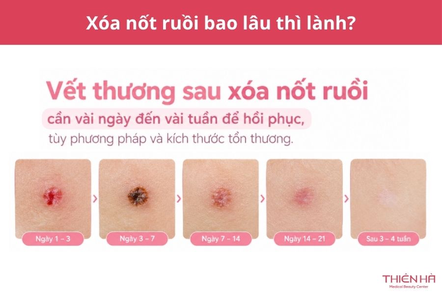 Xóa nốt ruồi an toàn: Phương pháp, chi phí và cách hạn chế sẹo 10 Xóa nốt ruồi có đau không?