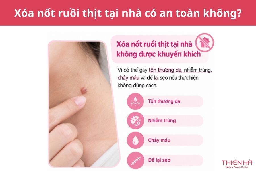 Xóa nốt ruồi thịt bằng cách nào? Phương pháp và chi phí thực hiện 8 Xóa nốt ruồi thịt tại nhà có an toàn không?
