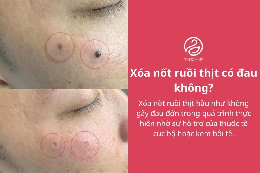 Xóa nốt ruồi thịt bằng cách nào? Phương pháp và chi phí thực hiện 4 Xóa nốt ruồi thịt có đau không?