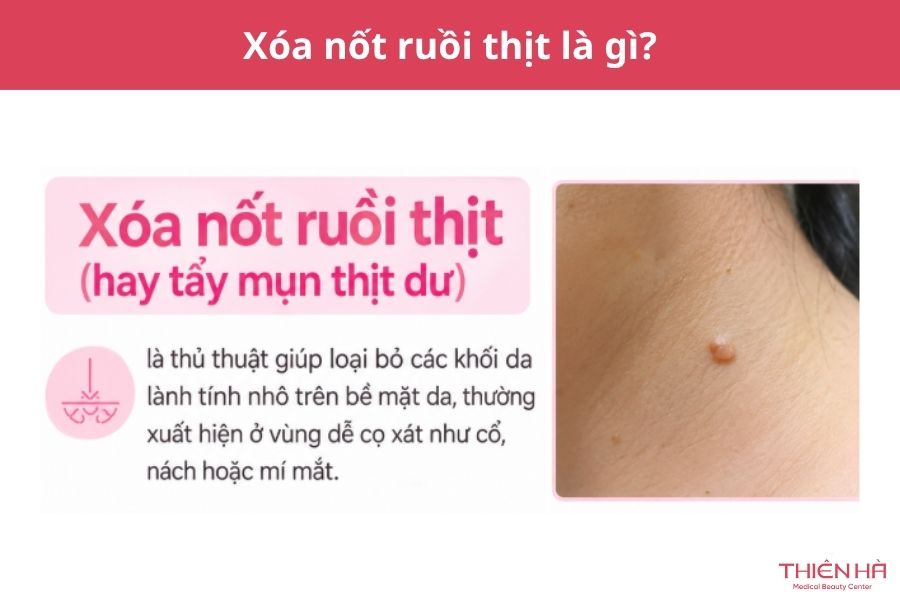 Xóa nốt ruồi thịt bằng cách nào? Phương pháp và chi phí thực hiện 1 Xóa nốt ruồi thịt là gì?