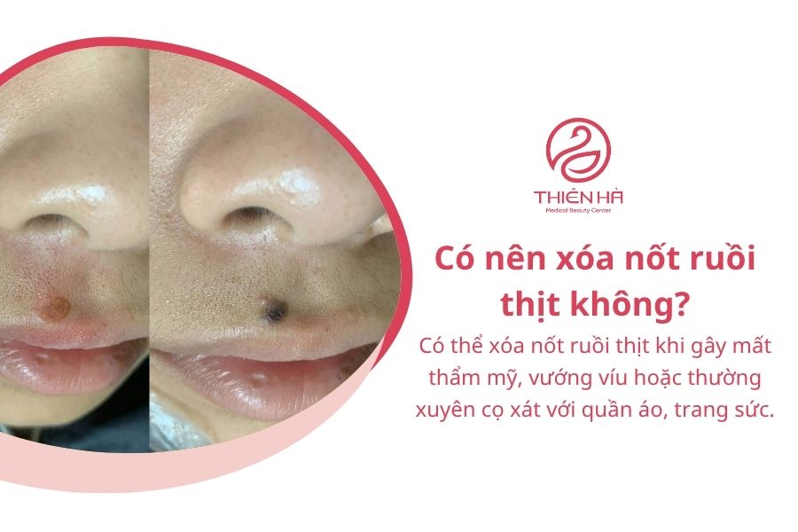 Xóa nốt ruồi thịt bằng cách nào? Phương pháp và chi phí thực hiện 2 Có nên xóa nốt ruồi thịt không?