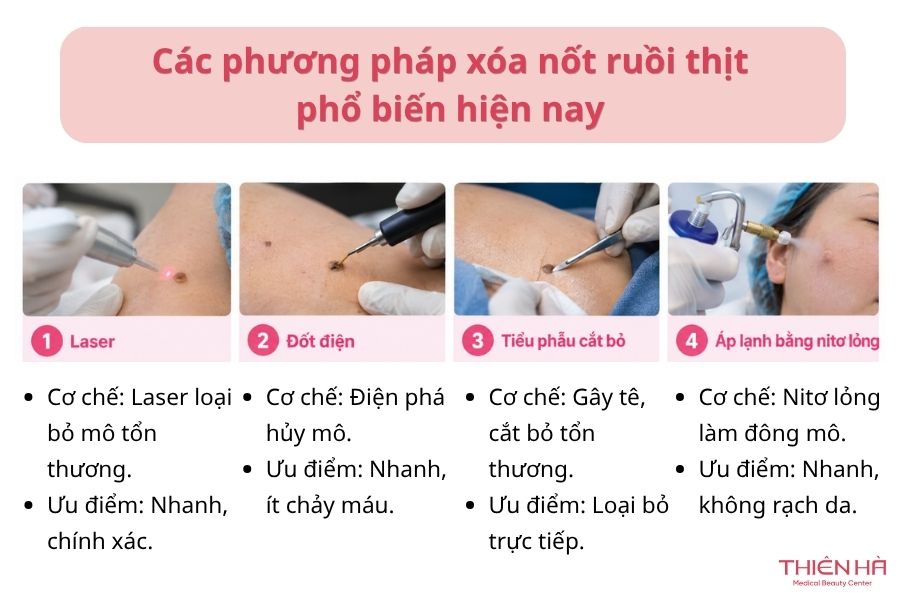 Xóa nốt ruồi thịt bằng cách nào? Phương pháp và chi phí thực hiện 3 Các phương pháp xóa nốt ruồi thịt phổ biến hiện nay