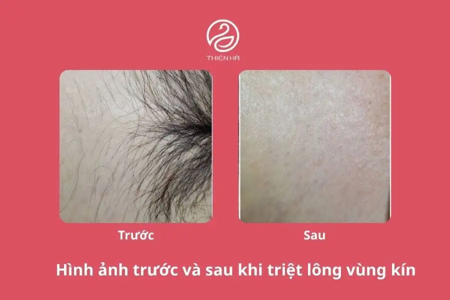Hình ảnh triệt lông bikini và các mẫu tạo hình đẹp 1 Hình ảnh sau khi triệt lông vùng kín