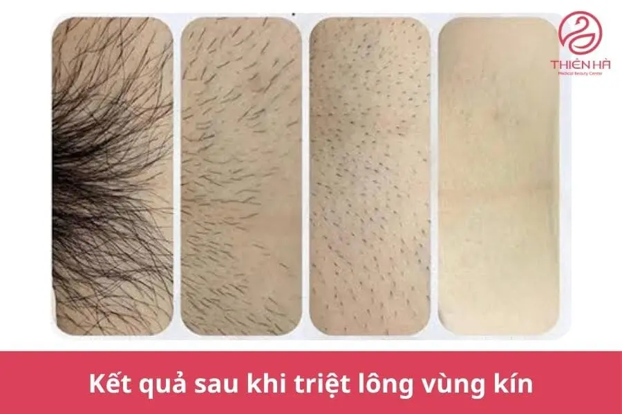 Hình ảnh triệt lông bikini và các mẫu tạo hình đẹp 2 Hình ảnh sau khi triệt lông vùng kín theo từng giai đoạn trong liệu trình triệt lông