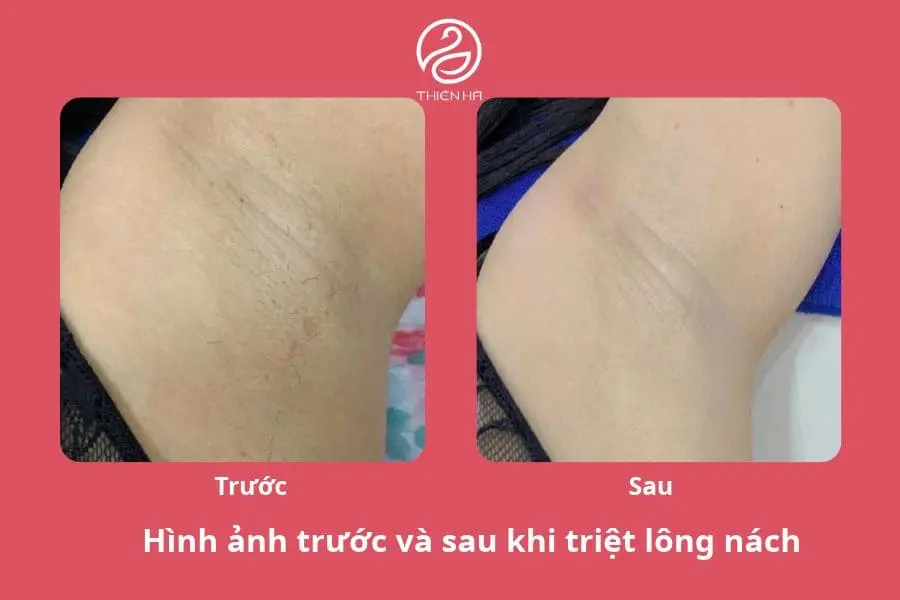 Hình ảnh triệt lông nách sau 7 buổi triệt 
