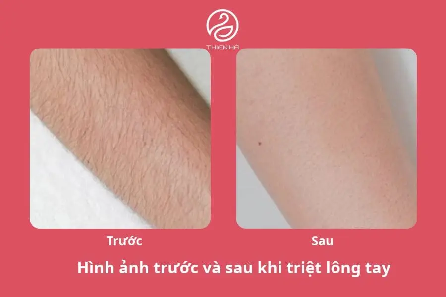 Hình ảnh triệt lông tay sau liệu trình triệt lông