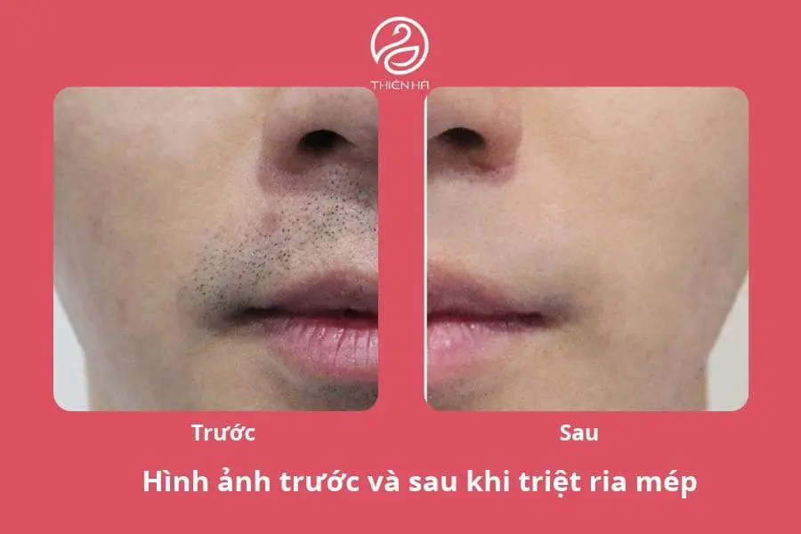 Hình ảnh thực tế trước và sau liệu trình 9 buổi triệt râu, ria mép 