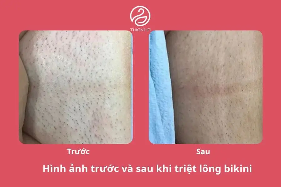 Hình ảnh thực tế trước và sau khi triệt lông vùng kín 