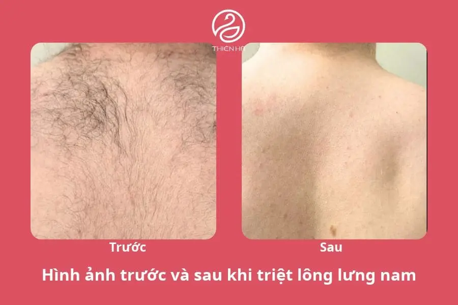 Hình ảnh thực tế trước và sau liệu trình triệt lông lưng ở nam giới 