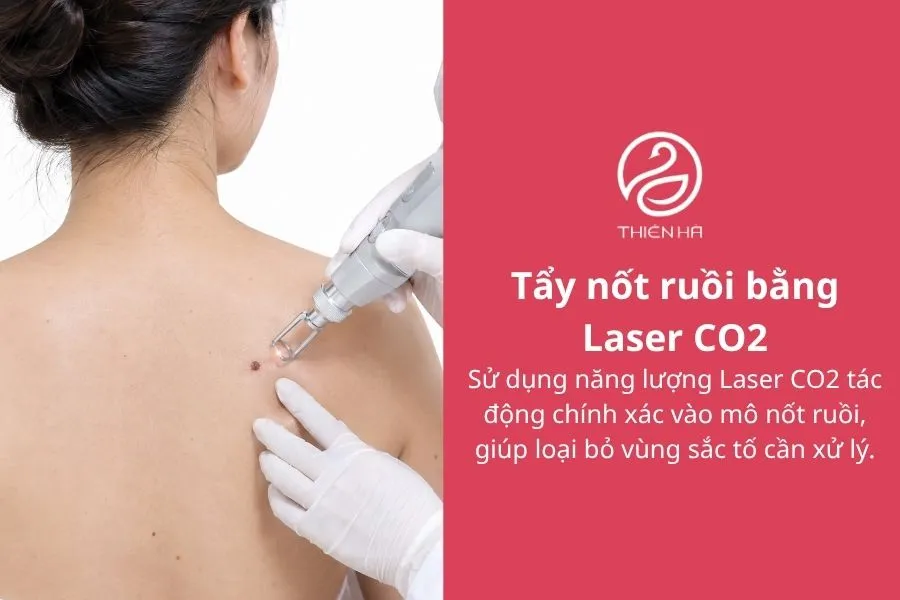 Kem tẩy nốt ruồi: Có an toàn không và nên tẩy bằng cách nào? 6 Tẩy nốt ruồi bằng Laser CO2