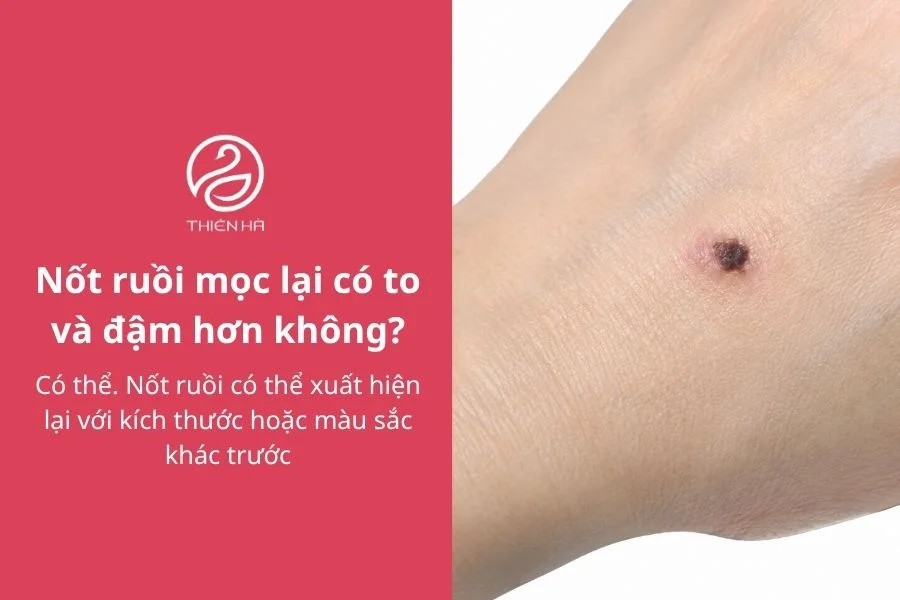 Câu hỏi thường gặp về nguyên nhân nốt ruồi mọc lại