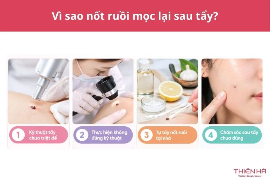 Vì sao nốt ruồi mọc lại sau khi tẩy?