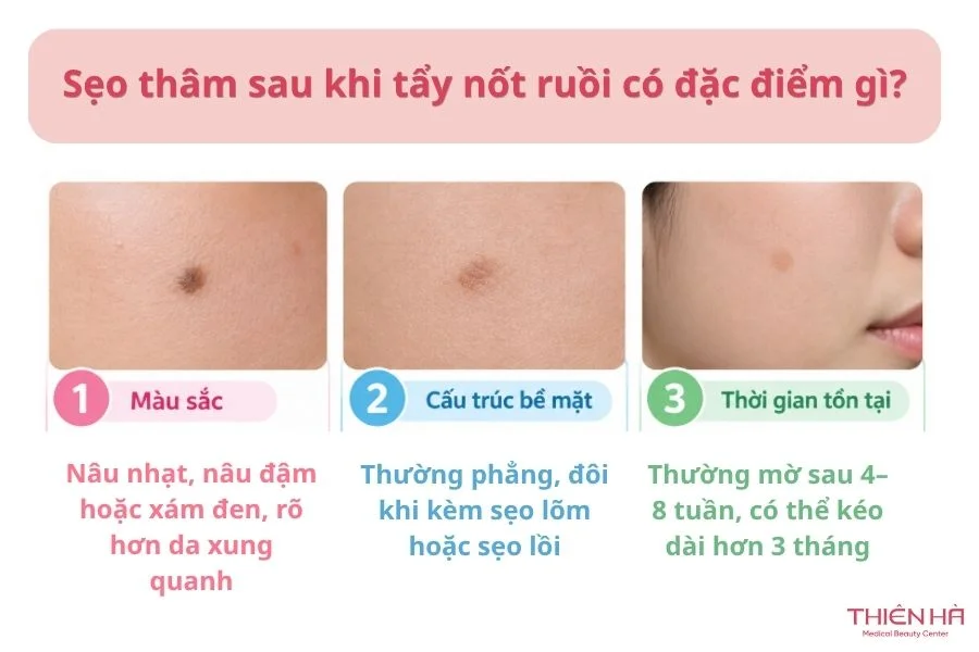 Sẹo thâm sau khi tẩy nốt ruồi có đặc điểm gì?