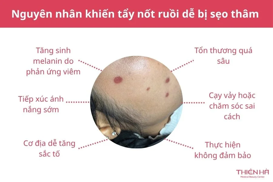 Nguyên nhân khiến tẩy nốt ruồi dễ bị sẹo thâm
