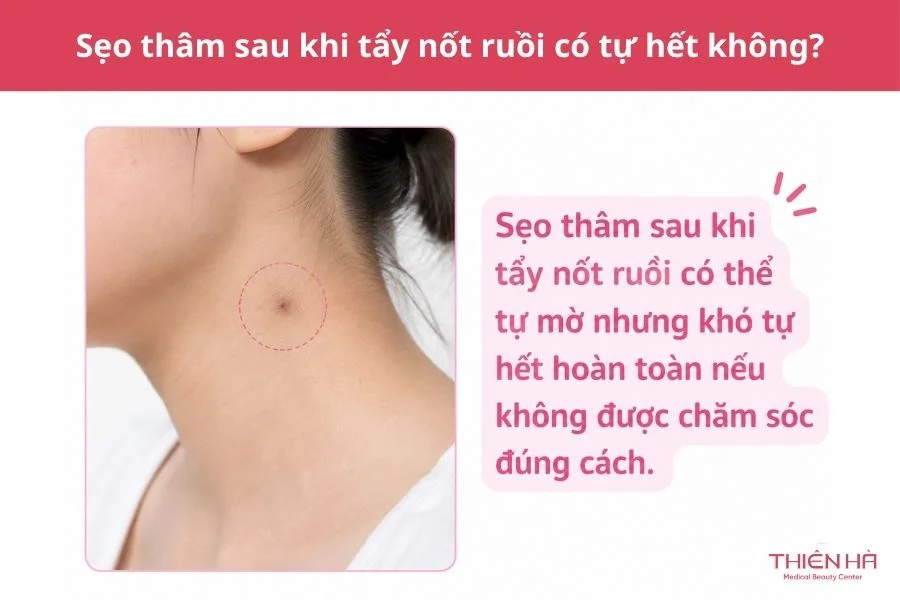 Sẹo thâm sau khi tẩy nốt ruồi có tự hết không?