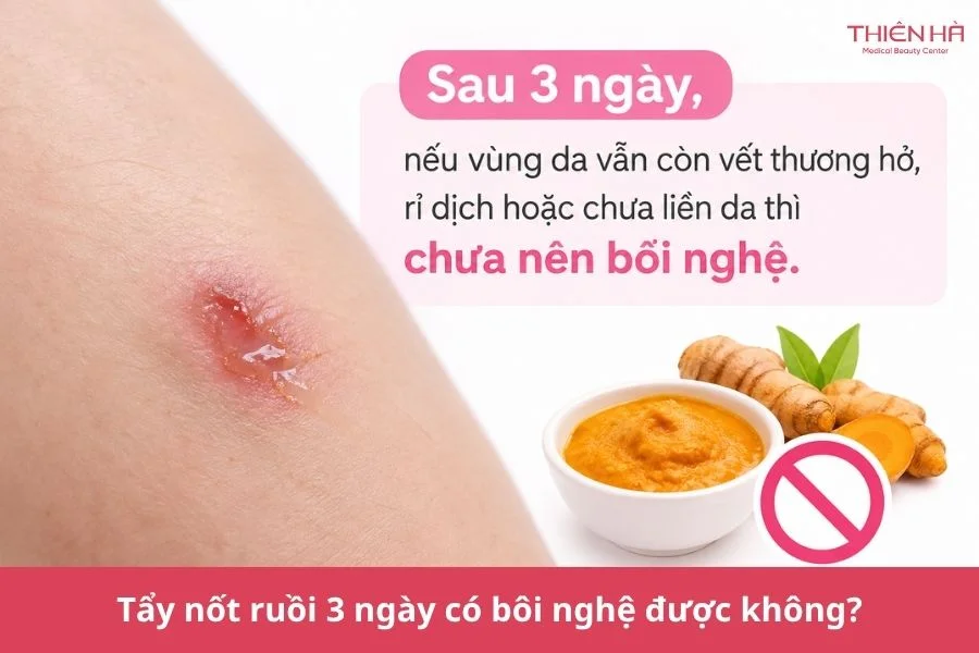 Câu hỏi thường gặp về bôi nghệ sau tẩy nốt ruồi