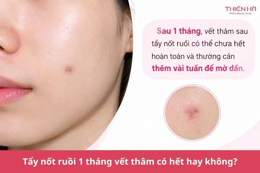 Tẩy nốt ruồi bao lâu thì hết thâm? Bí quyết giúp da đều màu hơn 5 Thắc mắc thường gặp về thâm sau tẩy nốt ruồi