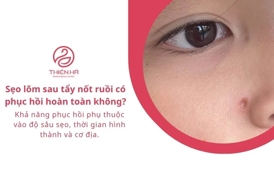 Câu hỏi thường gặp về sẹo lõm sau tẩy nốt ruồi
