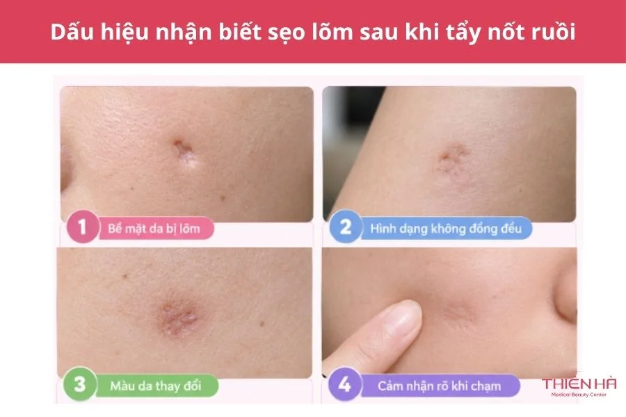 Dấu hiệu nhận biết sẹo lõm sau khi tẩy nốt ruồi