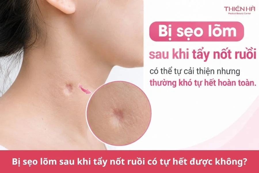 Bị sẹo lõm sau khi tẩy nốt ruồi có tự hết được không?