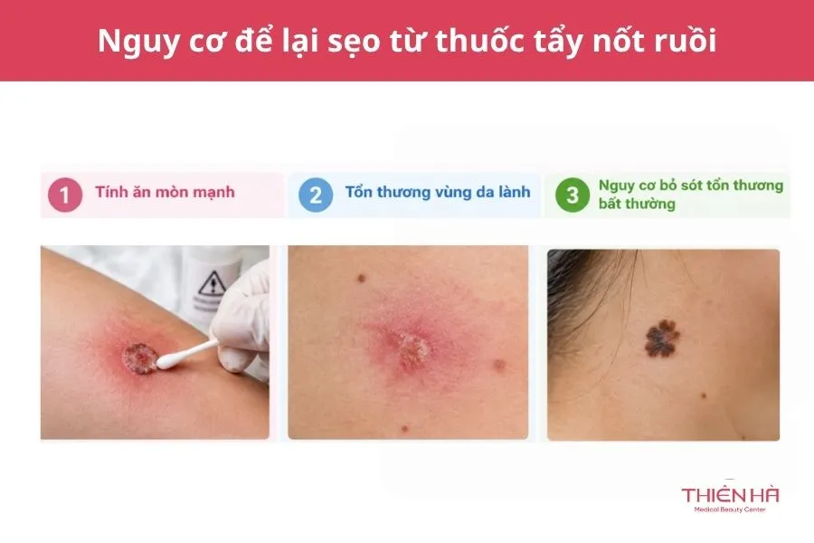Thuốc tẩy nốt ruồi Nga có gây sẹo không?
