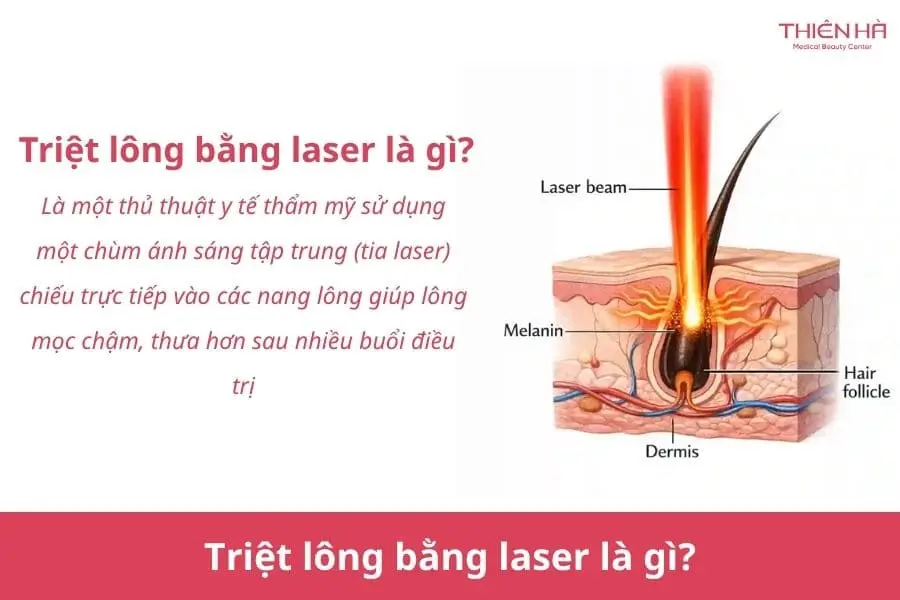 Triệt lông bằng Laser: Hiệu quả, chi phí và lưu ý 1 Triệt lông bằng laser là gì?
