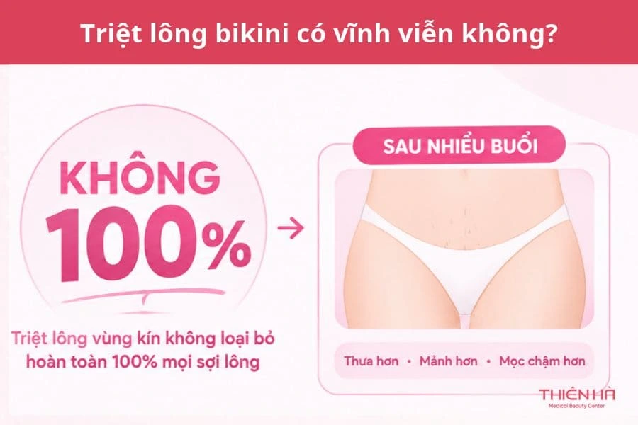Triệt lông bikini là gì? Công nghệ và hiệu quả 2 Triệt lông bikini có vĩnh viễn không?