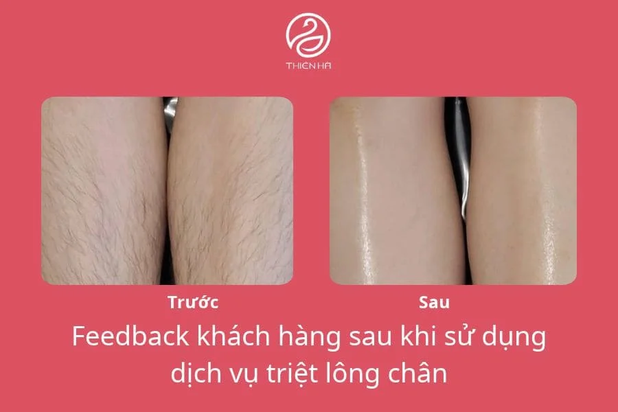 Có nên triệt lông chân không? Những điều cần biết 7 Hình ảnh thực tế trước và sau khi triệt lông chân tại Thẩm mỹ viện Thiên Hà