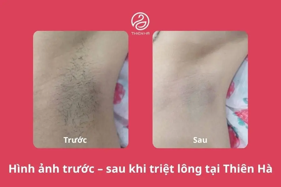 Hình ảnh trước và sau khi triệt lông nách được 8 buổi tại Thiên Hà, vùng cánh sáng màu rõ rệt