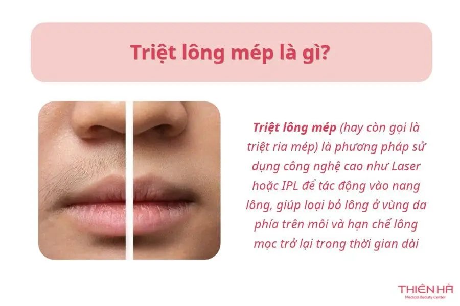 Triệt lông mép là gì?