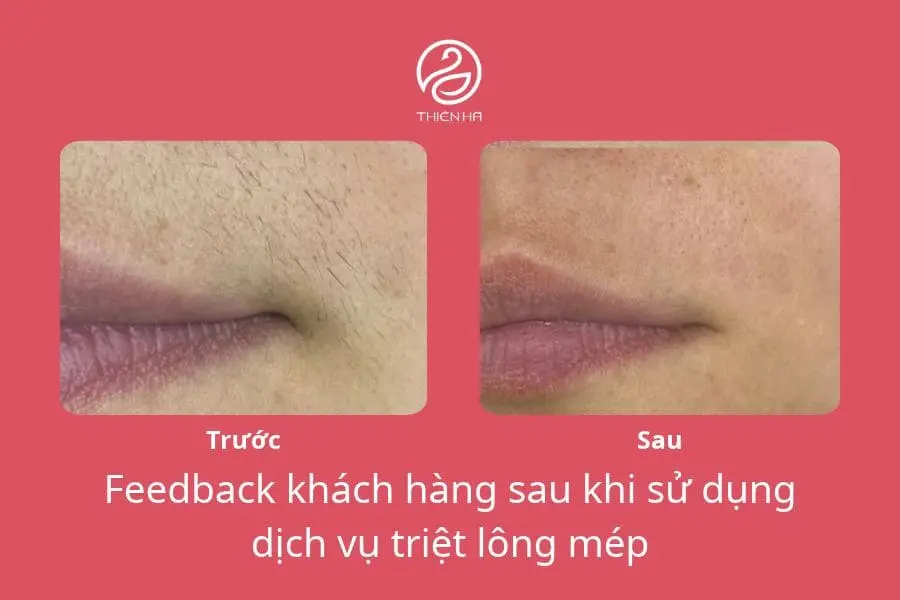 Hình ảnh thực tế trước và sau khi triệt lông mép