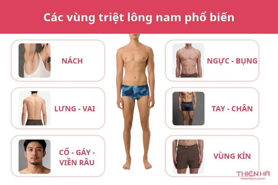 Các vùng triệt lông nam phổ biến