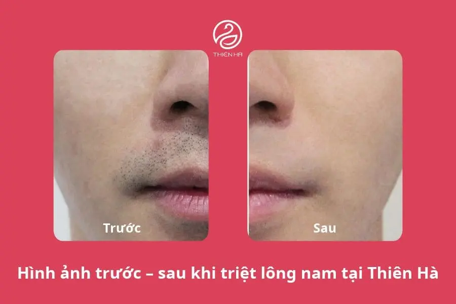 Hình ảnh thực tế trước và sau khi triệt lông nam tại Thẩm mỹ viện Thiên Hà