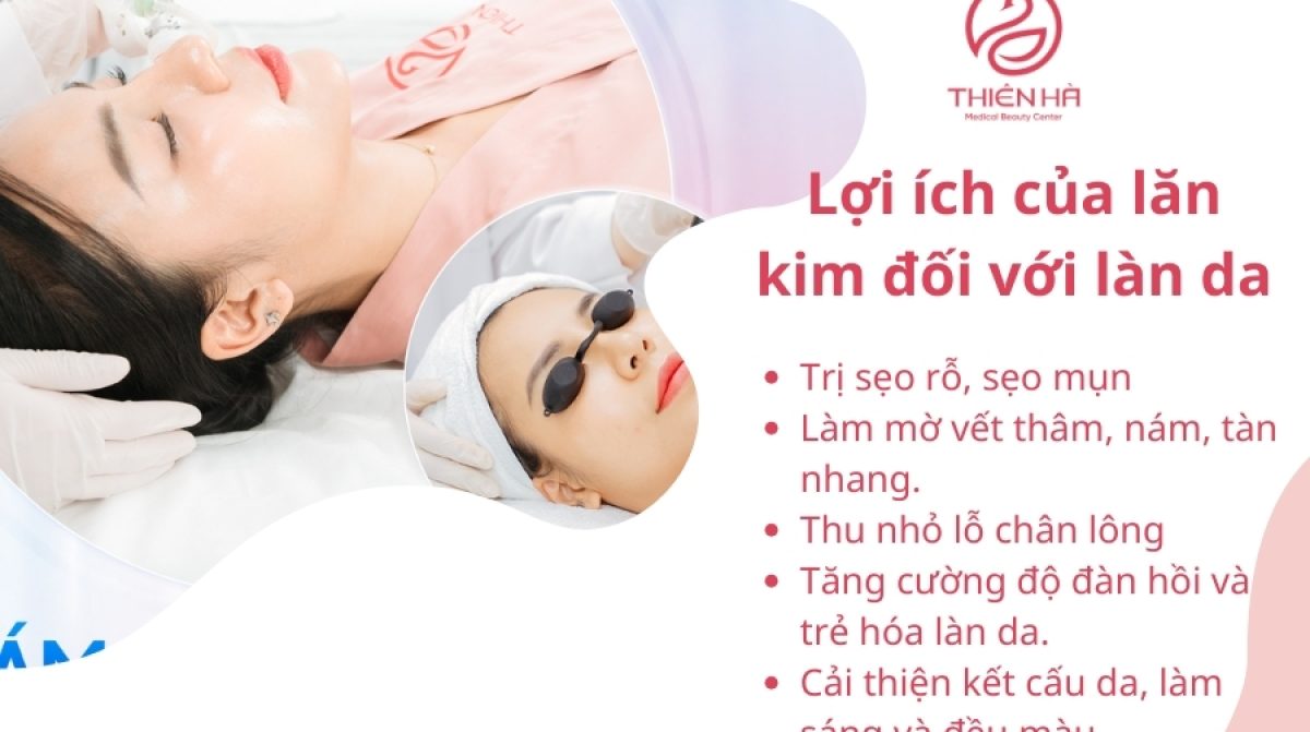 1 liệu trình lăn kim bao nhiêu tiền? Bảng giá mới nhất