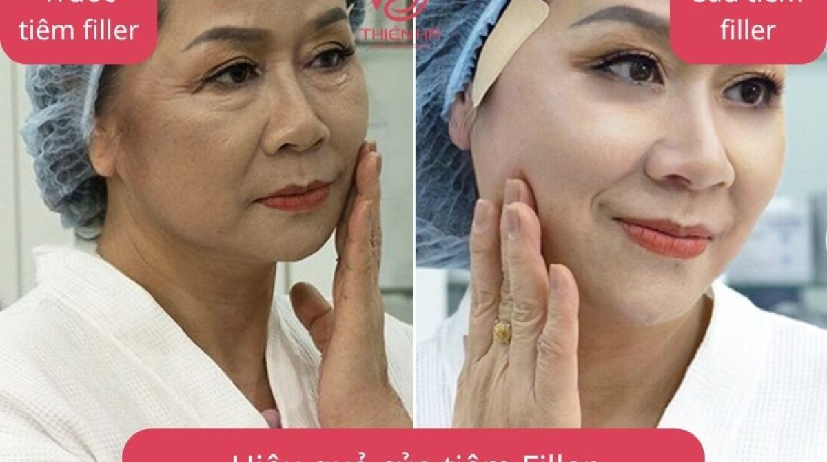 Filler Teoxane Giá Bao Nhiêu? Bảng Giá Chi Tiết Tại Thiên Hà