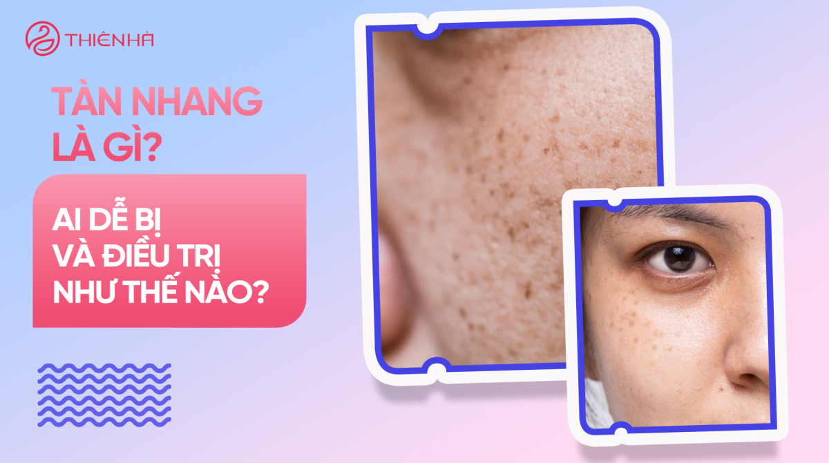 Tàn nhang là gì? Ai dễ bị và điều trị như thế nào?