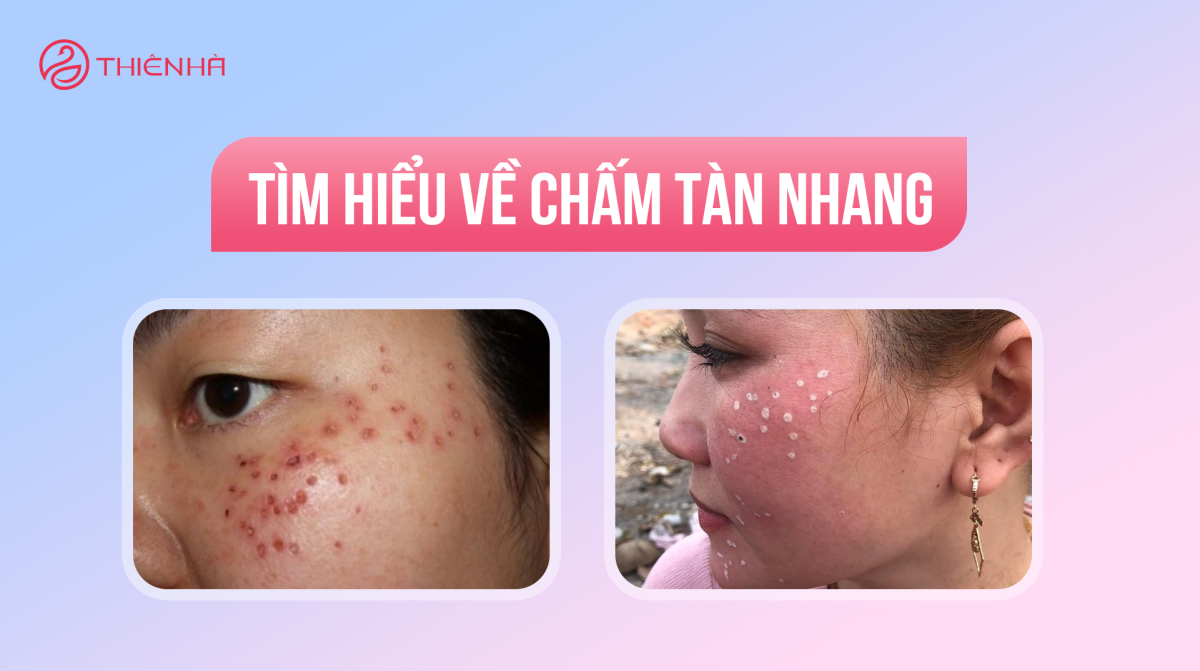 Tìm hiểu về chấm tàn nhang: Ưu điểm và rủi ro