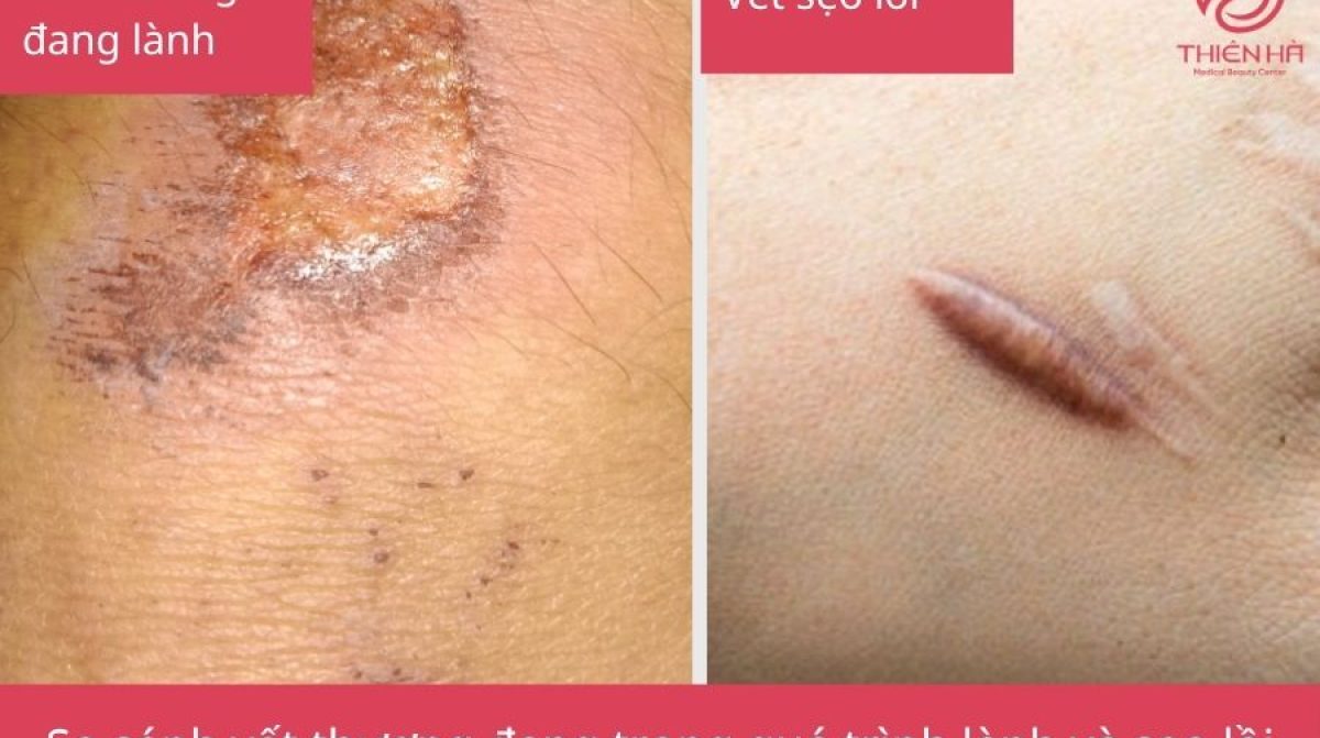 Ăn thịt gà có bị sẹo lồi không? Lời giải đáp từ chuyên gia