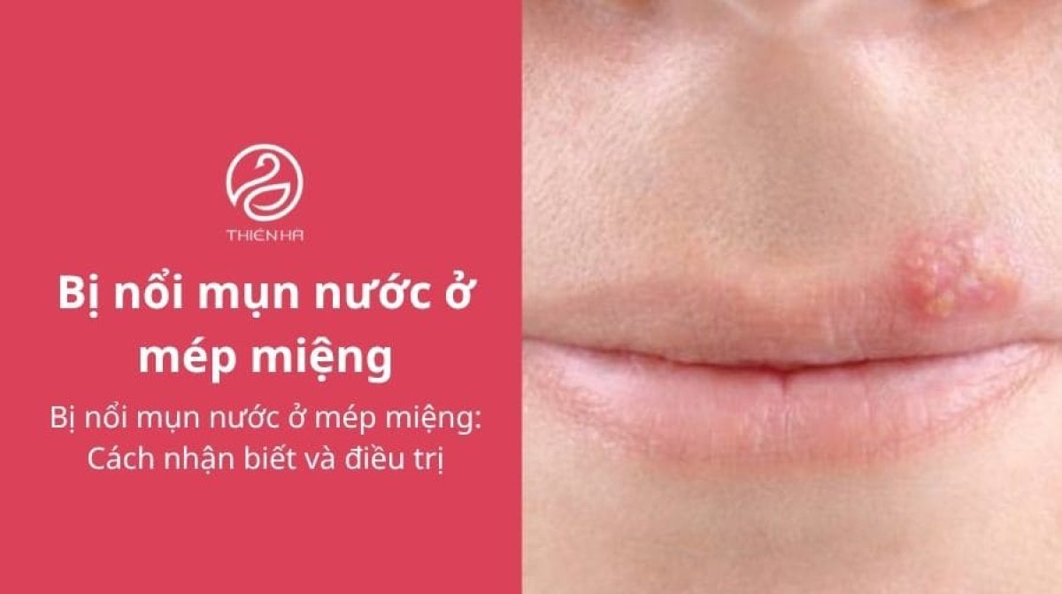 Bị nổi mụn nước ở mép miệng: Cách nhận biết và điều trị