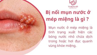 Bị nổi mụn nước ở mép miệng là gì? Nguyên nhân và cách xử lý an toàn