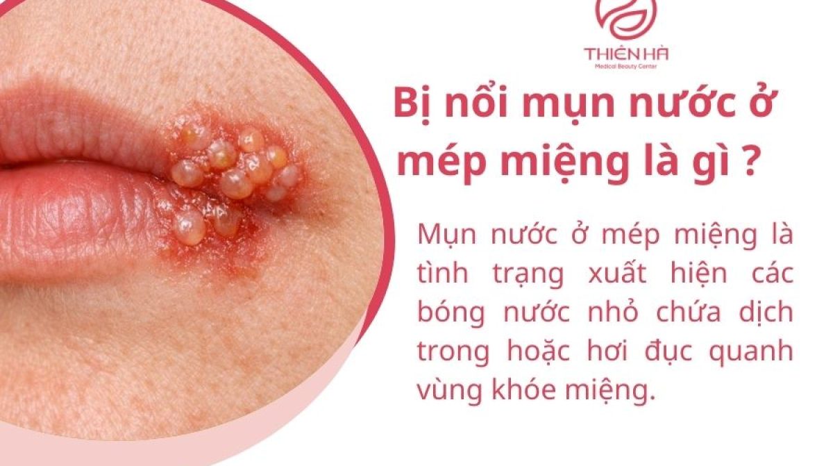 Bị nổi mụn nước ở mép miệng là gì? Nguyên nhân và cách xử lý an toàn