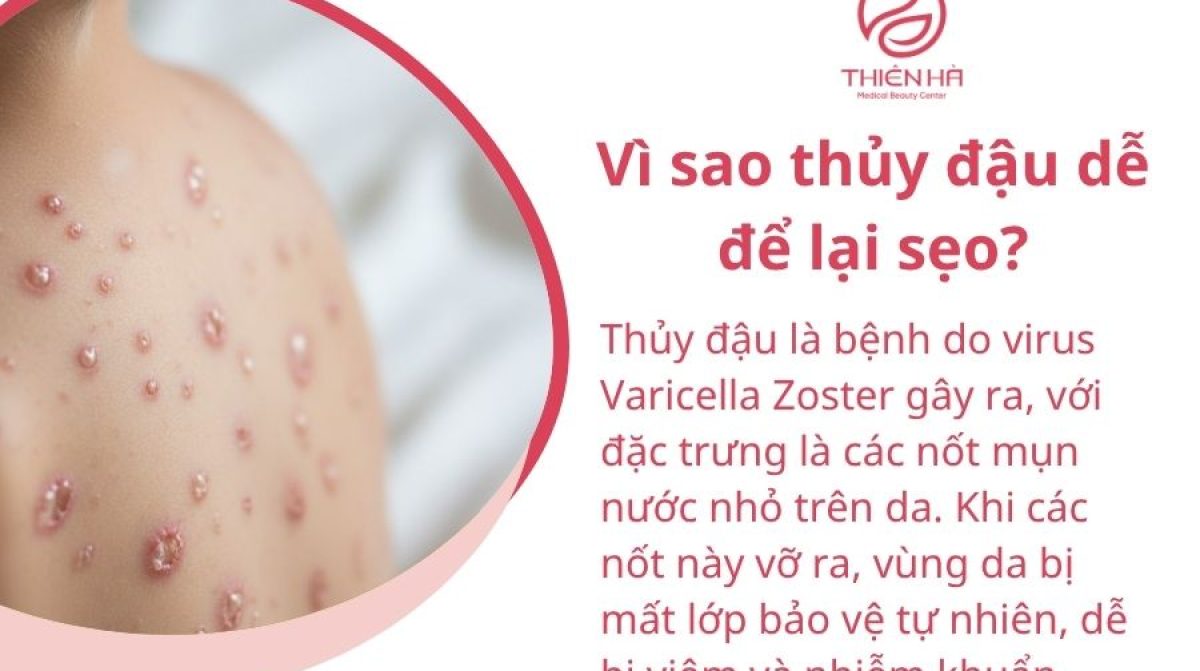 Bị thủy đậu kiêng gì để không bị sẹo? Danh sách bác sĩ khuyên