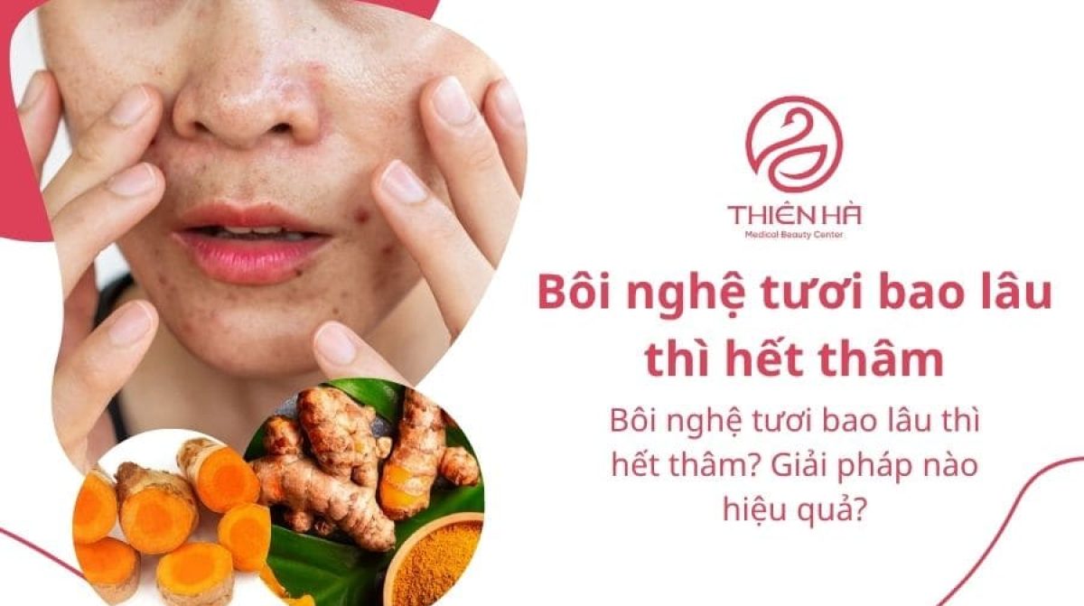 Bôi nghệ tươi bao lâu thì hết thâm? Giải pháp nào hiệu quả?