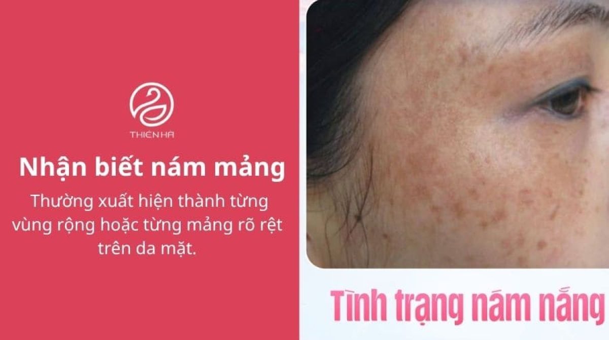 Các loại nám da phổ biến: Nhận biết sớm, trị đúng ngay