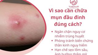 Cách chữa mụn đầu đinh đúng cách: Giảm đau nhanh, tránh biến chứng