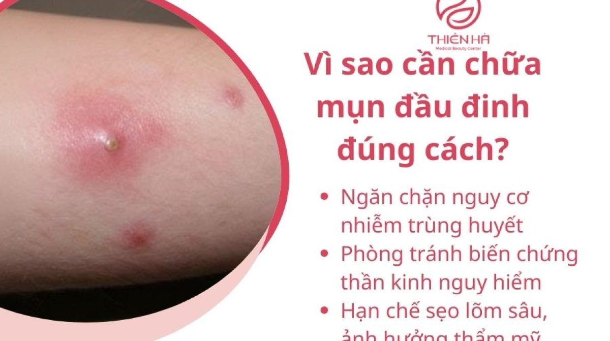 Cách chữa mụn đầu đinh đúng cách: Giảm đau nhanh, tránh biến chứng