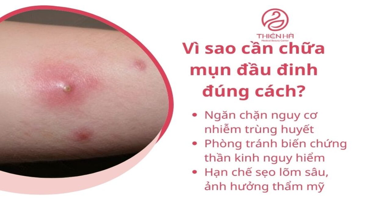 Cách chữa mụn đầu đinh đúng cách: Giảm đau nhanh, tránh biến chứng