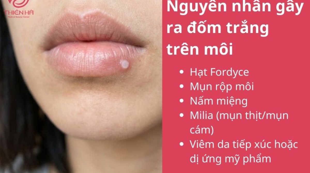Cách chữa mụn trắng ở môi an toàn theo từng nguyên nhân